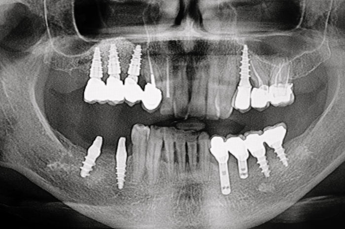 Dott. Procaccini – Grande rialzo con inserimento impianti